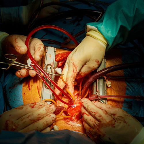 Aortic Surgery

